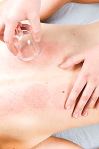 Schröpfen/Schröpfkopfmassage
